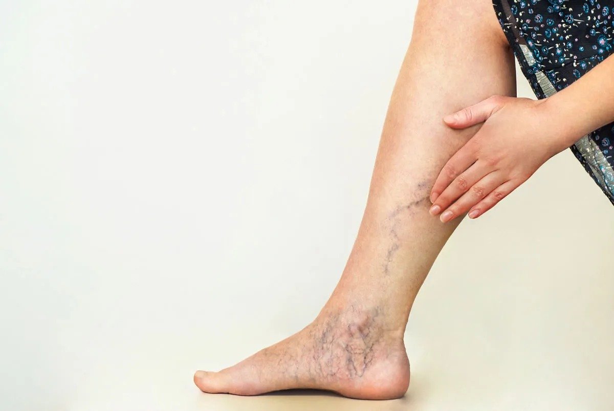 Varicose Veins Oil