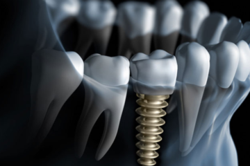 Dental Implants