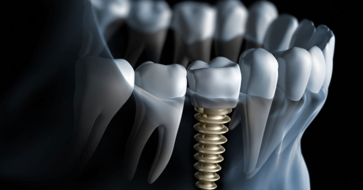 Dental Implants