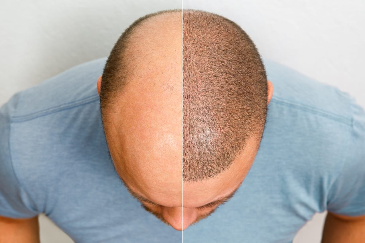 How to Find an Affordable Hair Transplant Clinic 