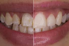 How Orthodontists And Prosthodontists Work Together For Smile Design