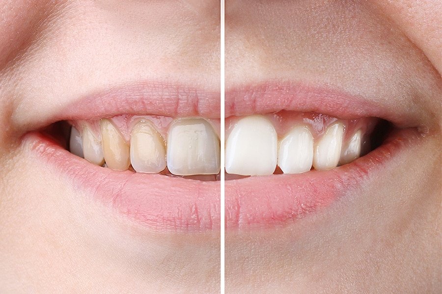 3 Advantages of Professional Teeth Whitening Vs. At Home Kits